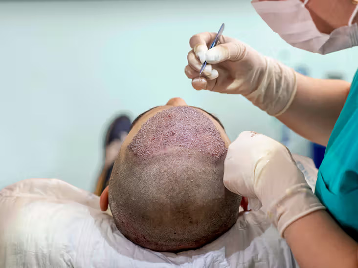 Hair transplant in agra