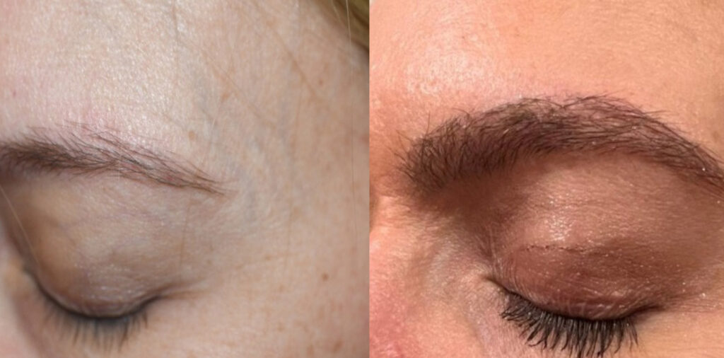 eyebrow reconstruction